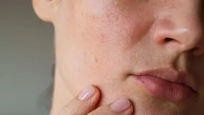 ബ്ലാക്ക്ഹെഡ്സ് മാറ്റി മുഖം സുന്ദരമാക്കാം; വീട്ടിലുണ്ട് പ്രതിവിധി...