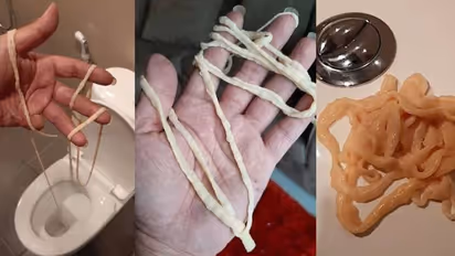 ശൗചാലയത്തിലെത്തിയ യുവാവ് മലദ്വാരത്തിൽനിന്ന് പുറത്തെടുത്തത് 32 അടി നീളമുള്ള വിര