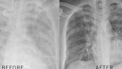 അപൂർവ രോഗം കാരണം ശ്വാസ തടസം നേരിട്ടു, ശസ്ത്രക്രിയയിലൂടെ ശ്വാസകോശം വൃത്തിയാക്കി, യുഎഇയിൽ ചരിത്ര സംഭവം