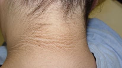 കഴുത്തിന് ചുറ്റുമുള്ള കറുപ്പ് അകറ്റാൻ ഇവ ഉപയോ​ഗിക്കാം