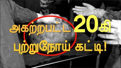 முதல் முறையாக...175 வருடத்தில் எழும்பூர் மருத்துவமனையில்... 20 கிலோ கேன்சர் கட்டி அகற்றம்...!