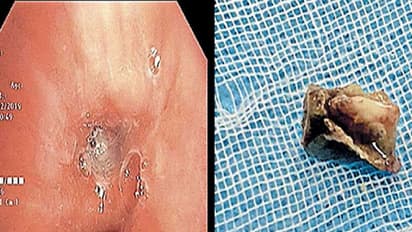 വര്ഷങ്ങളായി വിട്ടുമാറാതെ ന്യുമോണിയ; ശ്വാസകോശത്തില് നിന്ന് കണ്ടെത്തിയത് മീന്തല