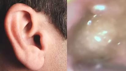 ചെവിവേദനയ്ക്ക് യുവാവ് മുറിവൈദ്യം പരീക്ഷിച്ചു; ചെവിയിൽ തിരുകിക്കയറ്റിയത് വെളുത്തുള്ളിയുടെ അല്ലി, പിന്നീട് സംഭവിച്ചത്...