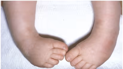 കുഞ്ഞുങ്ങളുടെ കാല്പ്പാദത്തിലെ വളവ്; ഫലപ്രദമായ ചികിത്സയുമായി തിരുവനന്തപുരം മെഡിക്കല് കോളേജ്