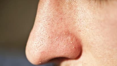 വൈറ്റ്ഹെഡ്സ് എങ്ങനെ ഒഴിവാക്കാം ? വീട്ടില് പരീക്ഷിക്കാവുന്ന ചില പൊടിക്കൈകള് നോക്കാം