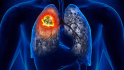 World Lung Day 2023 : നാല് പ്രധാനപ്പെട്ട ശ്വാസകോശ രോ​ഗങ്ങളെ കുറിച്ചറിയാം 