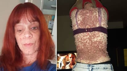 ശരീരമാകെ മുഴകള്; റോഡിലിറങ്ങിയാല് ആളുകളുടെ വെറുപ്പ് കാണണമെന്ന് യുവതി