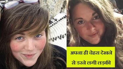 फैशनेबल दिखने के लिए लगाया डाई, गुच्छों में गिरने लगे बाल, फिर हुआ खौफनाक हाल