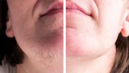 മുഖത്തെ രോമങ്ങൾ കളയാന്‍ ചില എളുപ്പ വഴികള്‍...