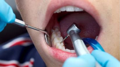 റൂട്ട് കനാൽ ചെയ്തതിന് പിന്നാലെ വേദന, ഉടന്‍ ശസ്ത്രക്രിയ ചെയ്തു; 19കാരൻ ഗുരുതരാവസ്ഥയിൽ