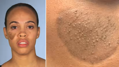 മുഖത്ത് ഗുഹ്യരോമവുമായി യുവതി; അപൂര്‍വ്വ പ്രതിഭാസത്തിന് പിന്നിലെ കഥ