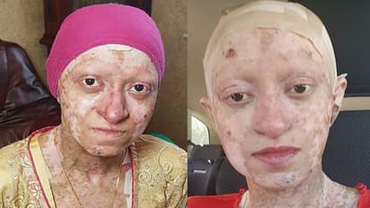 ചർമം പൊട്ടി പഴുപ്പ് വരും; ഭക്ഷണം പോലും കഴിക്കാൻ പറ്റാത്ത അവസ്ഥ; ജനിച്ച് അന്ന് മുതൽ ആസ്യയെ ഈ രോ​ഗം അലട്ടുന്നു