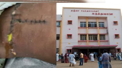 ரூ.12 லட்சம் செலவில் செய்ய வேண்டிய சிகிச்சையை இலவசமாக செய்து சாதனை... அரசு மருத்துவமனையை இலக்காரமாக நினைக்காதீர்கள்..!