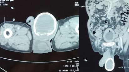 80 കാരന്റെ വൃഷണത്തില് കട്ടിയുള്ള എന്തോ തടഞ്ഞു; പരിശോധിച്ച ഡോക്ടര്മാര് അമ്പരന്നു !