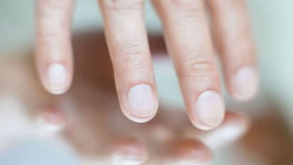 ಉಗುರ ಮೇಲೆ ಬಿಳಿ ಕಲೆಯಾಗಿದ್ಯಾ? ಮುಖದಲ್ಲಿ ಎಣ್ಣೆ ಇಳೀತಿದ್ಯಾ?  ಪೋಷಕಾಂಶಗಳ ಕೊರತೆಯಾಗಿದೆ ಎಂದರ್ಥ!