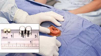 കോപ്പിയടിക്കാന് ഉപയോഗിച്ച ഉപകരണങ്ങള് ചെവിയ്ക്കുള്ളില് കുടുങ്ങി; 15 വിദ്യാര്ത്ഥികള് ശസ്ത്രക്രിയക്ക് വിധേയരായി