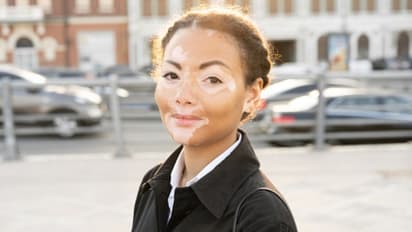 ত্বকের এই সমস্যাকে ভয় নয়, জেনে নিন শ্বেতী রোগের খুঁটিনাটি