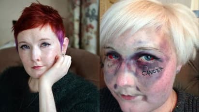 മരണത്തെ പേടിച്ചിരുന്നില്ല... യുവതി രക്താർബുദവുമായി ജീവിച്ചത് 13 വർഷം; 28ാം വയസിൽ മരണത്തിന് കീഴടങ്ങി