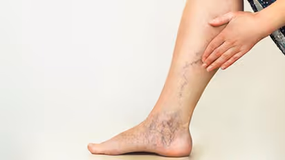 ಕಾಲಿನಲ್ಲಿ ನೀಲಿ ರಕ್ತನಾಳಗಳಿವೆಯೇ? ಇದು ಯಾವ ರೋಗದ ಲಕ್ಷಣ ಎಂದು ತಿಳಿದಿದೆಯೇ?