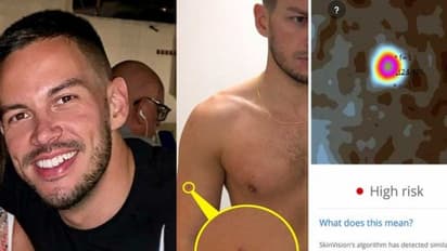 സ്കിന് ക്യാന്സറില് നിന്ന് 31കാരന് രക്ഷപ്പെട്ടത് തന്റെ മൊബൈല് ഫോണിലെ ഒരു ആപ്പിലൂടെ...