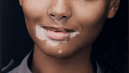 வெண்புள்ளி பிரச்சனைக்கு  மருந்து கண்டுபிடிப்பு...!  பல ஆண்டு போராட்டத்திற்கு பின் கிடைத்த நிரந்தர தீர்வு..!