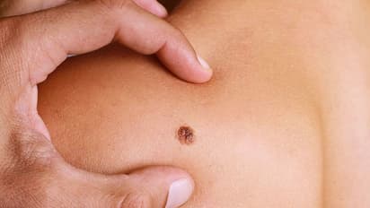 Skin Cancer Symptoms : സ്കിന്‍ ക്യാന്‍സര്‍ ; ഈ ലക്ഷണങ്ങൾ അവ​ഗണിക്കരുത് 