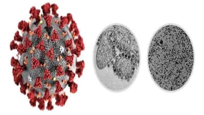 കാസര്‍കോട്ട് കൊറോണ വൈറസ് ബാധ സംശയത്തില്‍ ഒരാളെ കൂടി ആശുപത്രിയിലേക്ക് മാറ്റി