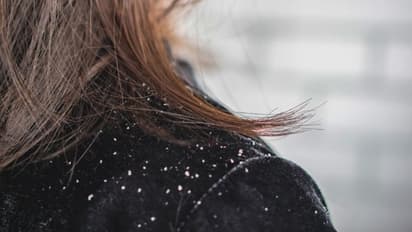 താരൻ അകറ്റാൻ ഒരു കിടിലന്‍ പൊടിക്കൈ!