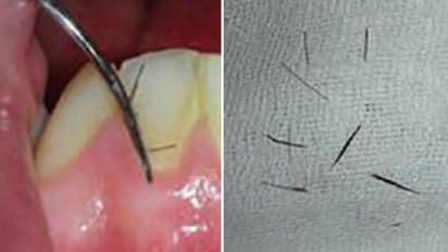 വായ്ക്കകത്ത് കണ്പീലികളുമായി യുവതി; കാരണം കണ്ടെത്തിയ ഡോക്ടര്മാര് അമ്പരന്നു!