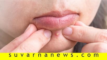 ಮುಖದ ತುಂಬ ಮೊಡವೆಗಳಿದ್ದ ಹುಡುಗಿ ಮನೋವೈದ್ಯರ ಬಳಿ ಬಂದದ್ಯಾಕೆ?