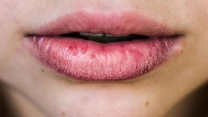 Dry Lips: பனிக்காலத்தில் உதடுகள் வறட்சியா? இதோ உங்களுக்கான சூப்பரான டிப்ஸ்!