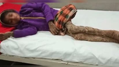 গাছের শুকনো ডালের মত আকার নিল পা,  বিরল রোগে আক্রান্ত  শিশুকন্যা