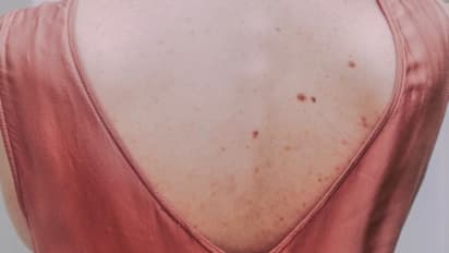 আপনার পিঠেরও একই অবস্থা, আজ থেকে ব্যবহার করুন এই অব্যর্থ টোটকা