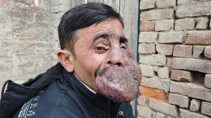 മുഖമാകെ പടര്ന്നുപിടിച്ച മുഴ; അപൂര്വ്വരോഗത്തിനിടെ നാട്ടുകാരുടെ ആരാധനയും