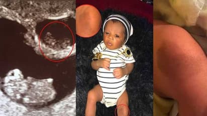 ഇരട്ടസഹോദരി ബാക്കി വച്ച അടയാളവുമായി ജനിച്ച 'അദ്ഭുത' ശിശു