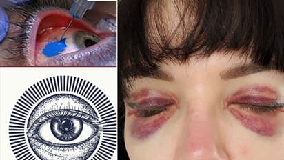 Girl tattoos eyeballs; goes blind trying to copy rapper