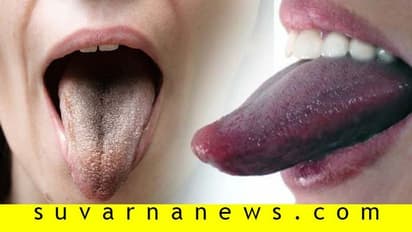 ನಾಲಿಗೆ ಬಣ್ಣವೇ ಹೇಳುತ್ತೆ, ಮನುಷ್ಯನ ಆರೋಗ್ಯ?