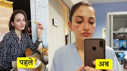 चेहरे पर लाल धब्बे...कोरोना मरीज के इलाज में लगी नर्स ने पोस्ट की Photo, लिखा, काम पर जाने से डरती हूं