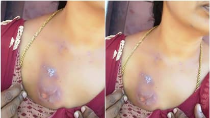 കൊവിഡ് പ്രതിരോധ പ്രവര്ത്തനത്തിനിടെ ആരോഗ്യ പ്രവര്ത്തകയ്ക്ക് സൂര്യതപമേറ്റു