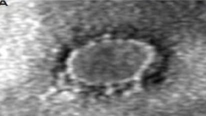 జమ్మలమడుగులో కరోనా పాజిటివ్ వ్యక్తి: ఏపీలో 14కు పెరిగిన సంఖ్య