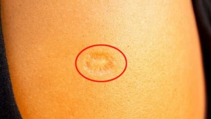 భారతీయుల భుజంపై మచ్చ.. డబ్ల్యూహెచ్‌వో ప్రయోగాలు: కరోనా నుంచి అదే కాపాడుతోందా..?