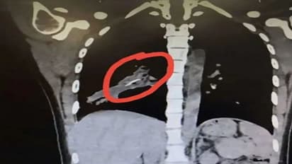 ಮಹಿಳೆ ಶ್ವಾಸಕೋಶದಲ್ಲಿ ಕಂಡುಬಂದ ವಸ್ತು ಕಂಡು ಹೌಹಾರಿದ ಡಾಕ್ಟರ್ಸ್!