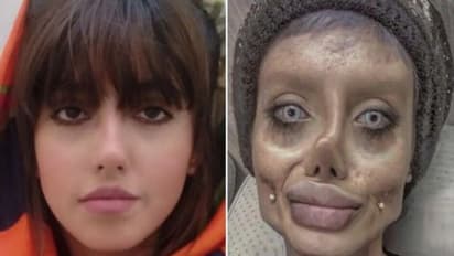 പ്ലാസ്റ്റിക് സര്ജറിയിലൂടെ ആഞ്ജലീന ജോളിയാകാന് ശ്രമിച്ച യുവതി കൊവിഡ് ബാധിച്ച് ഗുരുതരാവസ്ഥയില്