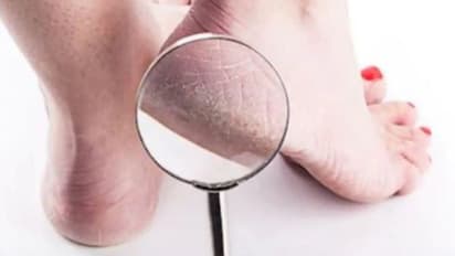 ഉപ്പൂറ്റി വിണ്ടുകീറല്‍; ഇതാ നാല് ഈസി ടിപ്സ്