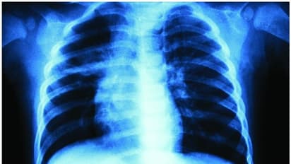 എക്സ് റേ പരിശോധനയിലൂടെ 5 മിനിറ്റിനുള്ളില് കൊവിഡ് 19 കണ്ടെത്താം, അവകാശവാദവുമായി ഐഐടി പ്രൊഫസര്