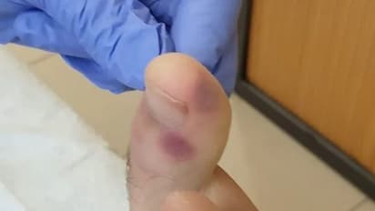 ಹೆಪ್ಪಗಟ್ಟುವ ರಕ್ತ: ಚರ್ಮ ಬದಲಾದರೆ ನಿರ್ಲಕ್ಷಿಸಬೇಡಿ...