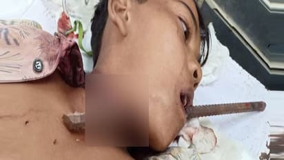 खेल-खेल में मुंह के आरपार हुई लोहे की सरिया, डेढ़ घंटे की मशक्कत के बाद बची लड़के की जान