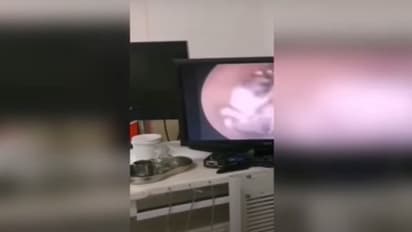 സ്ത്രീയുടെ ചെവിക്കുള്ളില് വല കെട്ടി, താമസമാക്കി എട്ടുകാലി; തരിച്ചുപോകും ഈ വീഡിയോ കണ്ടാല്...