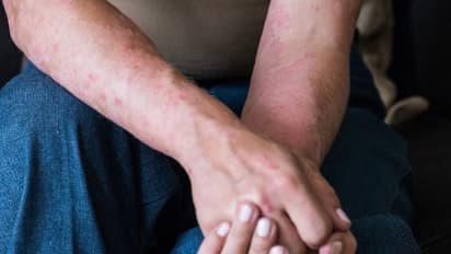 कोरोना वायरस के मरीजों में दिख रहे हैं 5 तरह के रैशेज, स्पेन के डॉक्टरों ने शुरू की स्टडी