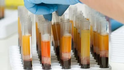 കൊവിഡ് രോഗിയുടെ മരണം; 'പ്ലാസ്മ തെറാപ്പി' അപകടമോ?